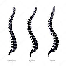 Your spine is a complex structure, made up of 33 individual bones (known as vertebra) stacked one on top of each other. Spinal Deformity Flat Vector Illustration Kyphosis Lordosis Of Spine Infographics Diagram With Spine Curvatures And Healthy Backbone Body Posture Defect Medical Educational And Science Banner Premium Vector In Adobe Illustrator Ai