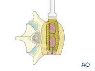 Lateral lumbar interbody fusion (LLIF) for Degenerative ...