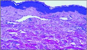 Nlike everything, they're easy when you know how. Inflammatory Breast Cancer The Disease The Biology The Treatment Robertson 2010 Ca A Cancer Journal For Clinicians Wiley Online Library