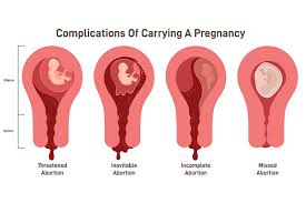 Medical diagram illustrating types of early pregnancy complications