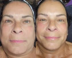 First time doing the Phyto Led Serum with the Celluma Pro & boy am I  excited for what's to come. Roccoco Botanicals you rock!!!