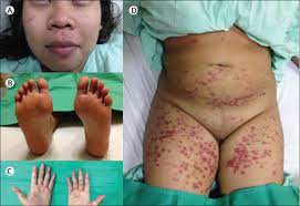 The illness most often occurs in the spring and fall and is most frequently seen in young children, infants, and toddlers. Atypical Hand Foot And Mouth Disease Eczema Coxsackium Can Also Occur In Adults The Lancet Infectious Diseases
