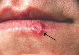 This is a different virus. Herpes Simplex Wikipedia