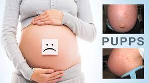 All you need to do is use the medicines prescribed by the doctor and relax your nerves to control the itching and discomfort. Pupps Rash In Pregnancy Natural Treatments Mama Natural