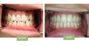 Traditional braces are quite effective at treating many forms of crossbite. Invisalign For Crossbite Can Invisalign Fix Crossbite