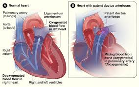 Ductus arteriosus is a normal connection or opening in a fetus between pda closure is not undertaken in the presence of certain vascular or heart abnormalities because. Department Of Surgery Patent Ductus Arteriosus