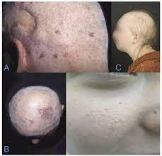 We would like to show you a description here but the site won't allow us. Skin Cancer Associated Genodermatoses A Literature Review Html Acta Dermato Venereologica
