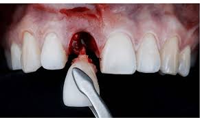 Image result for Tooth Extraction