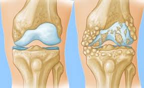 Widespread pain is defined as pain in the left side of the body, pain in the right side of the body, pain above the. Arthritis Of The Knee Orthoinfo Aaos
