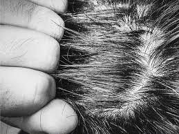 Image result for white scabs on the head in children