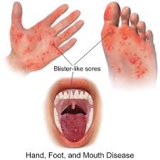 Image result for Hand foot and mouth disease HFMD roof of mouth