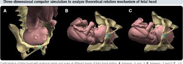 Image result for Manual Rotation in Occipitoposterior Presentation