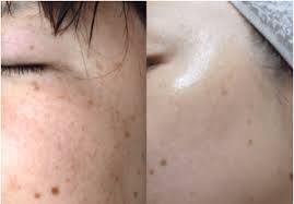 必見 ママ友の子供に 顔のシミ をホコリと間違えられた私が 1週間でシミを撃退した話 をしようと思う beauty cosme 顔のシミ 育毛 女性 美容