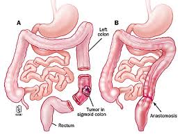 Mild to moderate diarrhea may occasionally persist for weeks to months after surgery, and some cats may have recurrent constipation. ç›´è‚›å¤–ç§' Colorectal Resections ç™½è¢ææ‡¼ç—‡ ç—žå®¢é‚¦