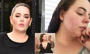 Tess Holliday shares up-close Instagram image of her acne