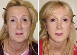 Chapter 23 SIMULTANEOUS FACELIFT AND FAT GRAFTING: COMBINED LIFTING AND  FILLING FOR REJUVENATION OF THE AGING FACE