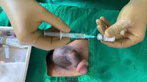 Image result for paraphimosis