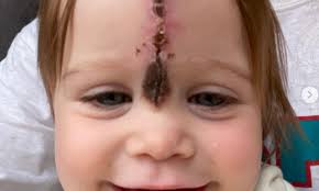 Dziewczynka przyszła na świat z niezwykłym znamieniem. Przeszła operację i  tak wygląda teraz