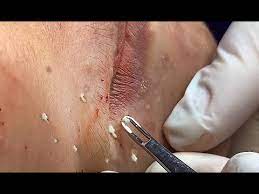 Mitesserentferner pickel ausdrücken werkzeug bonus inkl. Entfernen Sie Akne Im Gesicht Blackhead Pickel Ausdrucken Youtube