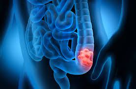 Memorial sloan kettering's guidelines recommend that you get screened for colon cancer beginning at age 45, if you have an average risk and no symptoms. 6 Ways To Prevent Colorectal Cancer Health Essentials From Cleveland Clinic