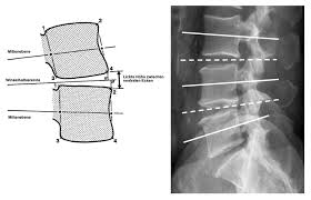 Maybe you would like to learn more about one of these? Medizinische Beurteilungskriterien Zu Bandscheibenbedingten Berufskrankheiten Der Lendenwirbelsaule I Springerlink