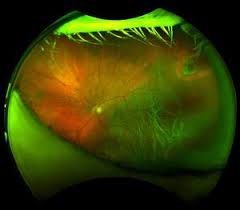Tearing of the retina may produce retinal or vitreous hemorrhages. Family Eye Care Of Shawneeoptomap