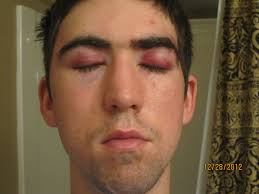 Ladybug Saga Author Lands Writing Job Despite Traumatic Brain Injury