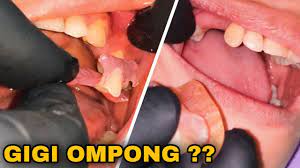 Check spelling or type a new query. Pemasangan Gigi Palsu Valplast Dokter Gigi Tri Putra Youtube