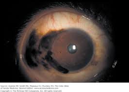 Image result for melanosis sclera