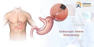 Pin On Stomach Surgery