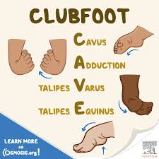 Image result for Clubfoot