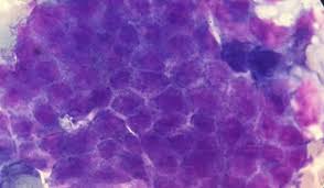 But if they are persistent, they may be due to ovarian cancer.istock. Imperial College Healthcare Nhs Trust Mri Tool That Can Diagnose Difficult Cases Of Ovarian Cancer To Be Tested At The Trust