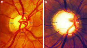 In glaucoma, the optic nerve head (beginning of the optic nerve, and visible while examining the retina as the optic disc) undergoes certain anatomical changes (referred to as cupping) that does not. Ophthalmoscopic Photographs Of Healthy And Glaucomatous Optic Discs Download Scientific Diagram