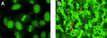 Image result for ANA Staining Pattern