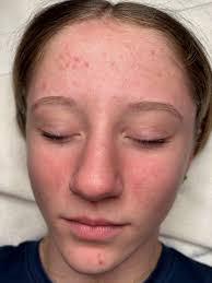 Emily Hansen Sessions (@emilysessions_skincare) • Instagram photos and  videos