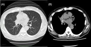 Image result for Broncholithiasis