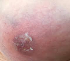 Pickel An Der Brust Was Konnte Es Sein Medizin Dermatologie