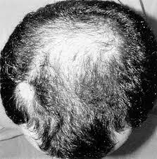 Hair loss in women can happen for a number of reasons, but that doesn't mean you have to settle for a thin head of hair. How Eucapil Works Eucapil Shop Deutschland Hair Care Agent For Topical Use In Androgenetic Alopecia Hair Loss