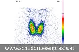 Bestimmter areale der schilddrüse bildlich dargestellt. Szintigrafie Der Schilddruse 1080 Wien