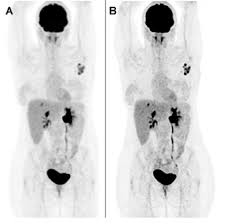 An mri scan of the breast may you'll also need tests that show whether the cancer will respond to specific types of treatment. Pet Ct Scan In The Staging Of Left Breast Cancer Detection Performed 1 Download Scientific Diagram