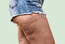 (back leg exercises, aka moves that target your hamstrings, glutes, and abductors, such as deadlifts are ideal for anyone trying to get rid of. How To Get Rid Of Cellulite On Thighs And Bum Namibiauraniuminstitute Com