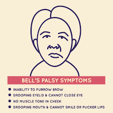 Bell's palsy is a nerve condition that causes partial or complete weakness of one side of the face. Bell S Palsy In Pregnancy The Pulse