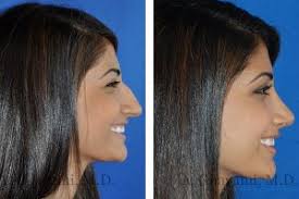More images for nose job before and after » Before After Nose Surgery Pictures In Beverly Hills Los Angeles Dr Ghavami