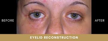 Image result for Eyelid Closure Defect