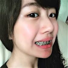 Black And White Braces Pin By John Beeson On Girls In Braces Braces Girls Cute Braces Metal Braces