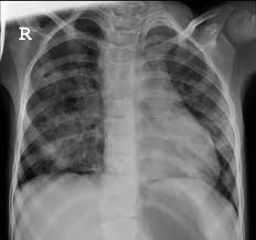 All patients underwent right, left or bilateral anterior thoracotomy according to the location of the hernia, followed by resection of the scar of the previous incision. Chest X Ray Showing Bilateral Haziness In The Lung Parenchyma Download Scientific Diagram