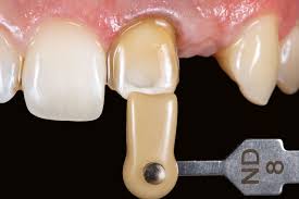 Check spelling or type a new query. Anterior Restorations Performance Of Ceramic Veneers Full Text At Quintessence Partner