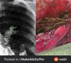 Browse our lung tree images, graphics, and designs from +79.322 free vectors graphics. A Tree Growing Inside Someone S Lung Natureismetal