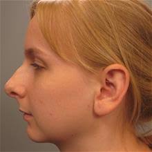 Chin Augmentation Before and After Photos by Gregory Mackay, MD; Atlanta,  GA