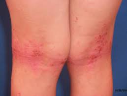 Hives rashes usually settle down within a few minutes to a few days. Rashes Affecting The Lower Legs Dermnet Nz
